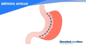 Redução do estômago por endoscopia: método Apollo em Lisboa. Doutor López-Nava Redução do estômago por endoscopia: método Apollo em Lisboa. Doutor López-Nava Quando Gontrand López-Nava agarra nos comandos do endoscópio, a sala de operaçoes prece transformar-se num salao de jogos. O gastroenterologista roda um e outro pulso, em movimentos amplos que se propagam ao resto do corpo. É a “manobra do toureiro”, compara ou nao fosse o médico de origem espanhola. No ecra, a equipa em sala – anestesista, enfermeiro, e outros gastroenterologistas que estao ali para ver López-Nava trabalhar – vai acompanhando o avanço da cirugia. Através da boca da paciente adormecida, López-Nava inseiru endoscópio, semelhante ao usado duramte um exame de diagnóstico. Dentro do aparelho que se assemelha a um agrafador. Assim que chega ao estômago, o médico, auxiliado pelo enfermeiro que ven com ele de Madrid, uma vez por mês, para realizar o procedimento no Hospital St. Louis, em Lisboa, começa a dar pontos na parede interna do órgao- A sutura atravessa todo o estômago, deixando-o com a forma de uma manga e com área útil, ou seja, capacidade para encher com comida, mais reduzida.