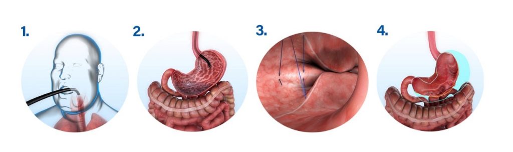 Tratamientos no invasivos para adelgazar Tratamientos no invasivos para adelgazar La obesidad es una de las mayores epidemias a las que se están enfrentando los profesionales de la salud en las últimas décadas. Actualmente, el 21% de los españoles tiene obesidad y esta cifra se eleva al 50% si hablamos de sobrepeso.